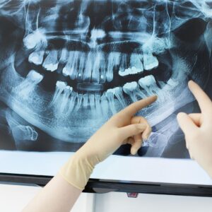 xray image of teeth