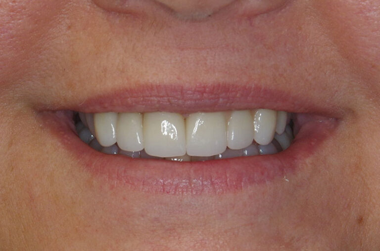 After Anterior esthetic crowns and implants