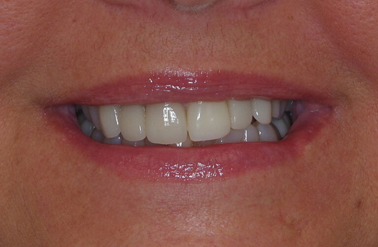 Before Anterior esthetic crowns and implants