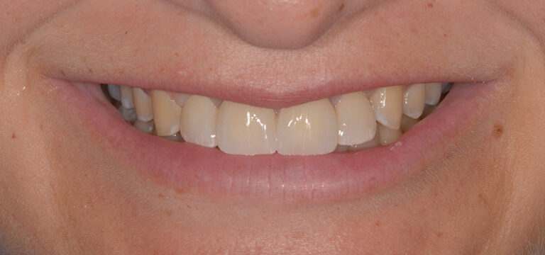 After Congenitally missing lateral incisor replacement with fixed bridge