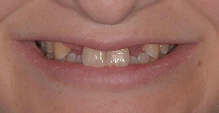 Before Congenitally missing lateral incisor replacement with fixed bridge
