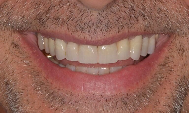 After Cosmetic reconstruction with crowns