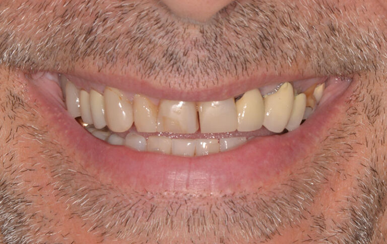 Before Cosmetic reconstruction with crowns