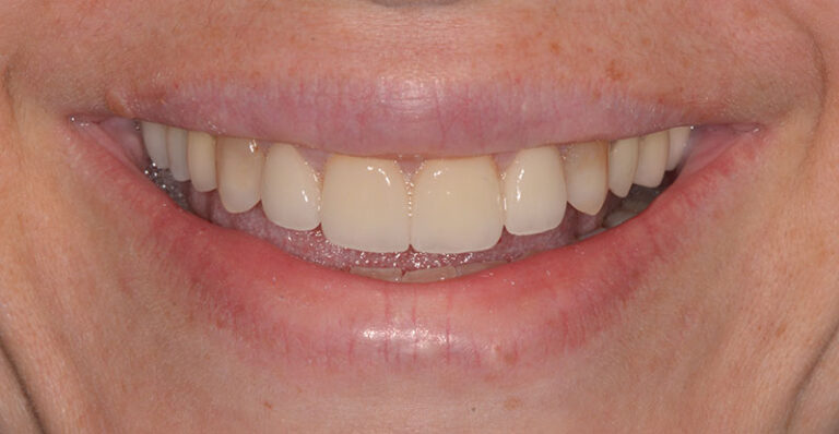 After Esthetic crowns to replace 4 incisors