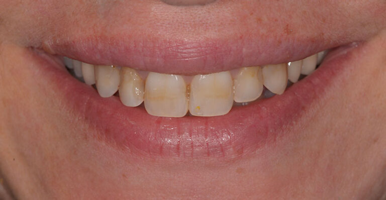 Before Esthetic crowns to replace 4 incisors