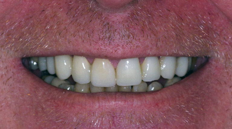After Esthetic reconstruction with implants and crowns