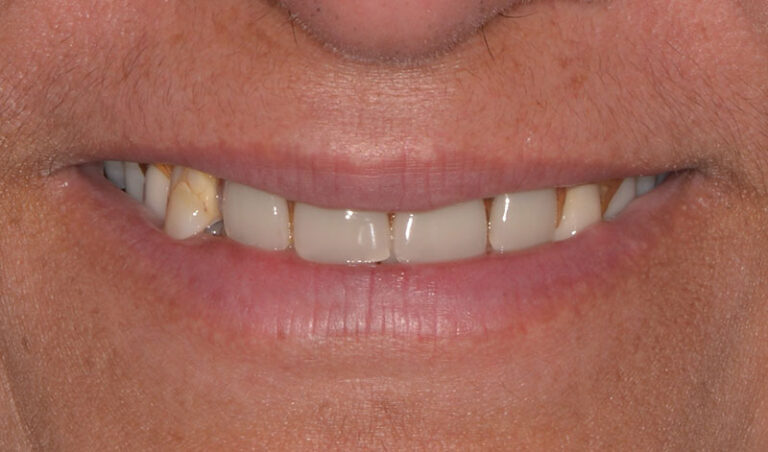 Before Full arch implants