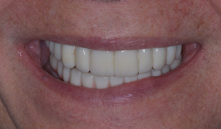 After Full mouth implants