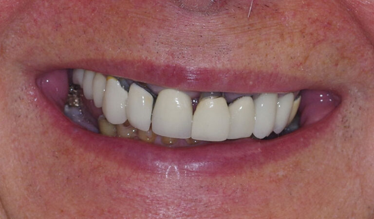 Before Full mouth implants