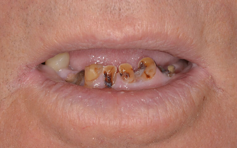 Before Full mouth reconstruction with implants