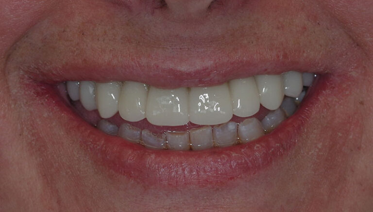 After Full upper arch implant reconstruction