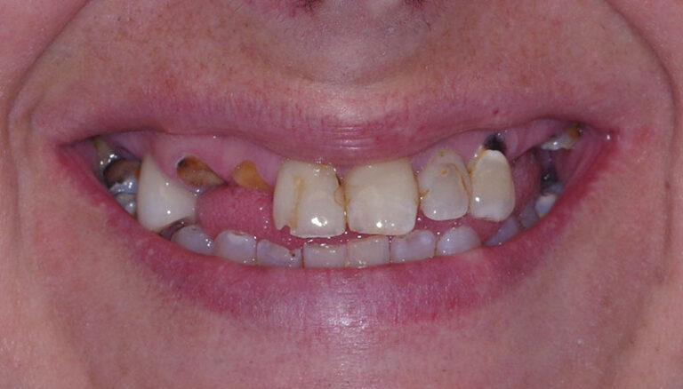 Before Full upper arch implant reconstruction