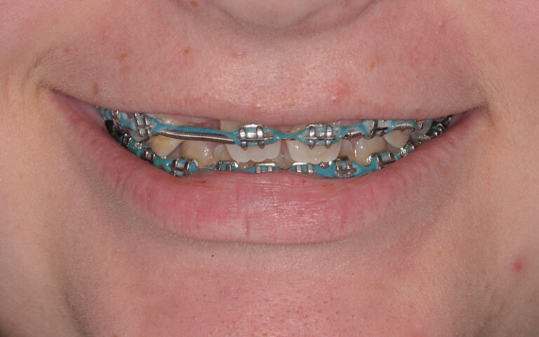 before Post orthodontic esthetic crowns