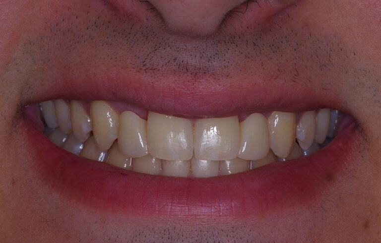 after Resin bonded Zirconia bridge for congenitally missing lateral incisors