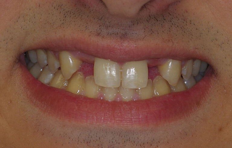 before Resin bonded Zirconia bridge for congenitally missing lateral incisors