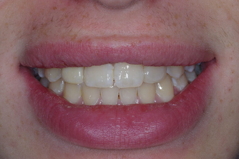 After Resin bonded Zirconia bridge for missing single lateral incisor