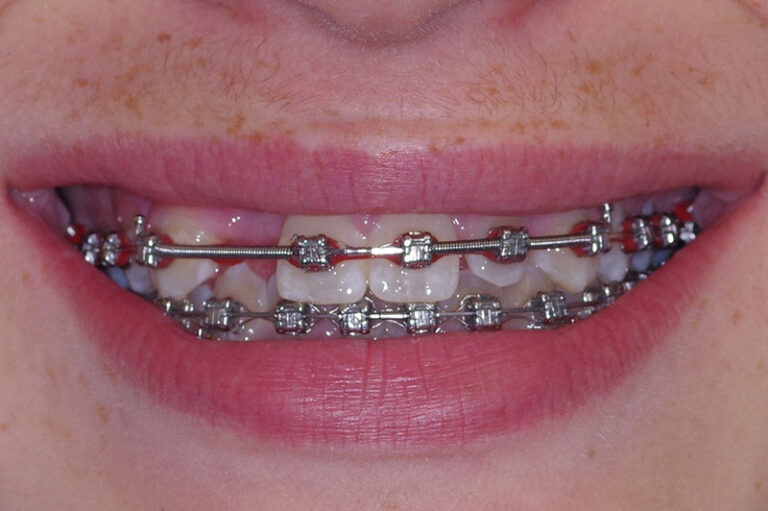 before Resin bonded Zirconia bridge for missing single lateral incisor