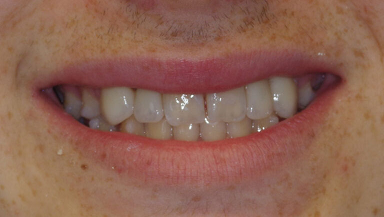 after Resin bonded Zirconia bridge to replace missing lateral incisors