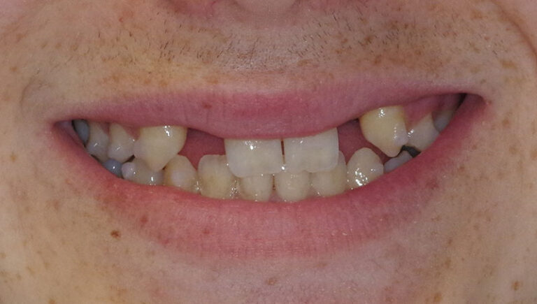 before Resin bonded Zirconia bridge to replace missing lateral incisors