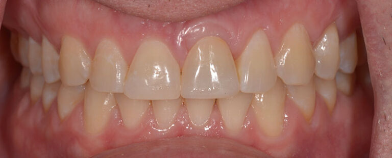 after Single incisor implant