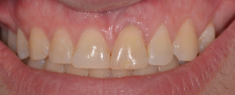 before Single incisor implant
