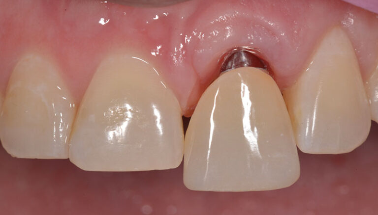 Single incisor implant