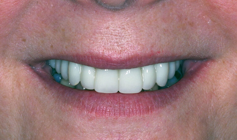 After Upper arch implant reconstruction