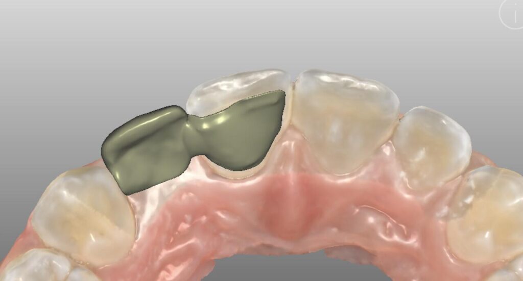 3D render of RBFDP attached from behind a neighboring tooth.