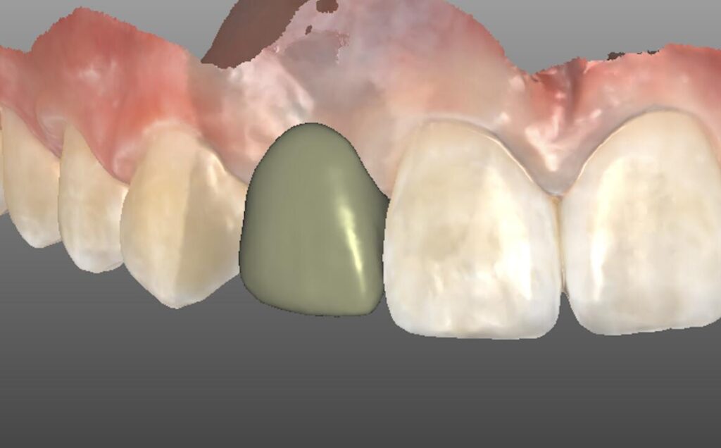 3D render of a RBFDP demonstrating near seamless integration.