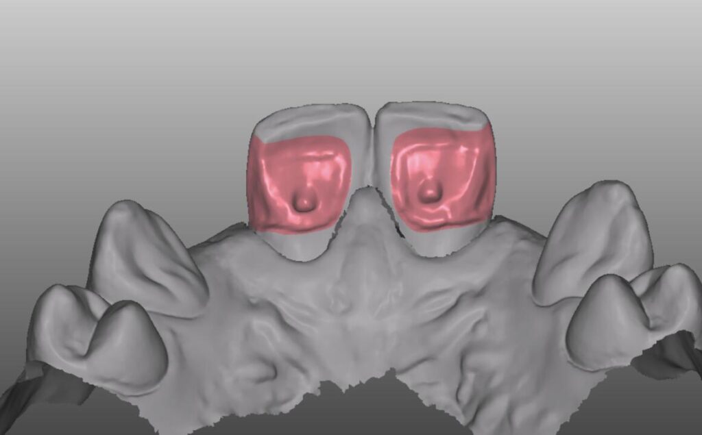Neighboring teeth may need preparation before missing lateral incisors can be replaced.