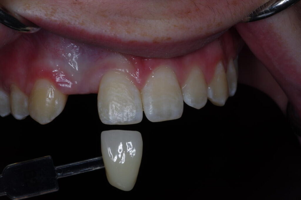 Careful attention during the final restoration phase can lead to natural-looking results.