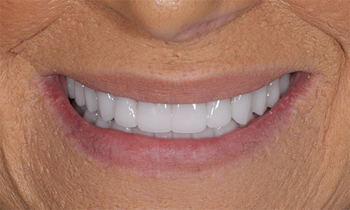 patient with dentures